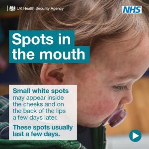 Ukhsa Measles Communications Toolkit 4
