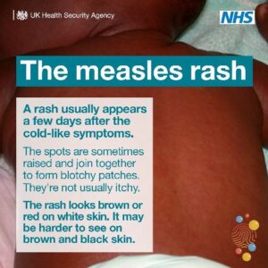 Ukhsa Measles Communications Toolkit 5
